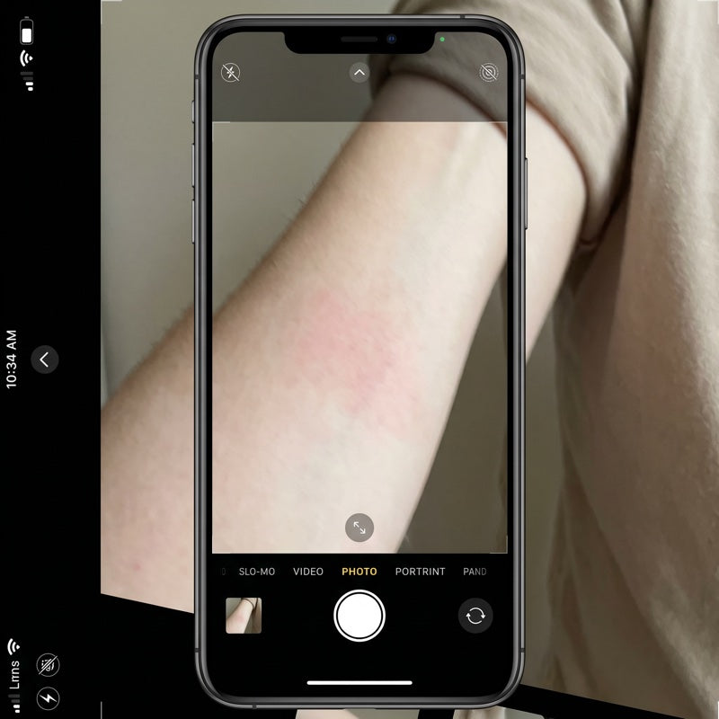 Forearm with mild faint pink areas at week 0