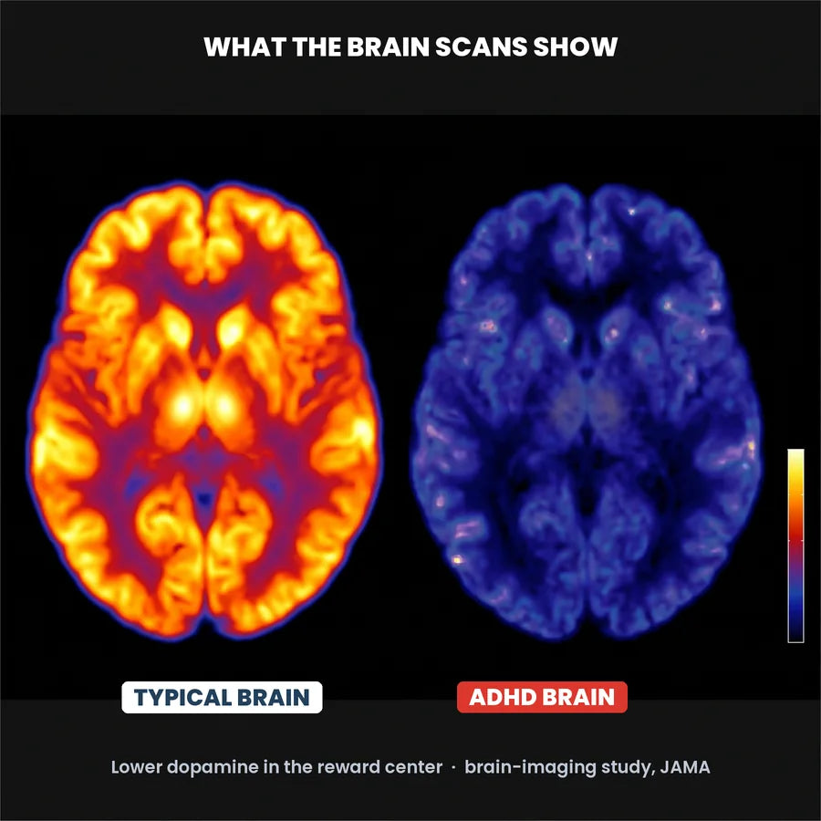 Brain scans showing lower dopamine in the reward centre of an ADHD brain versus a typical brain