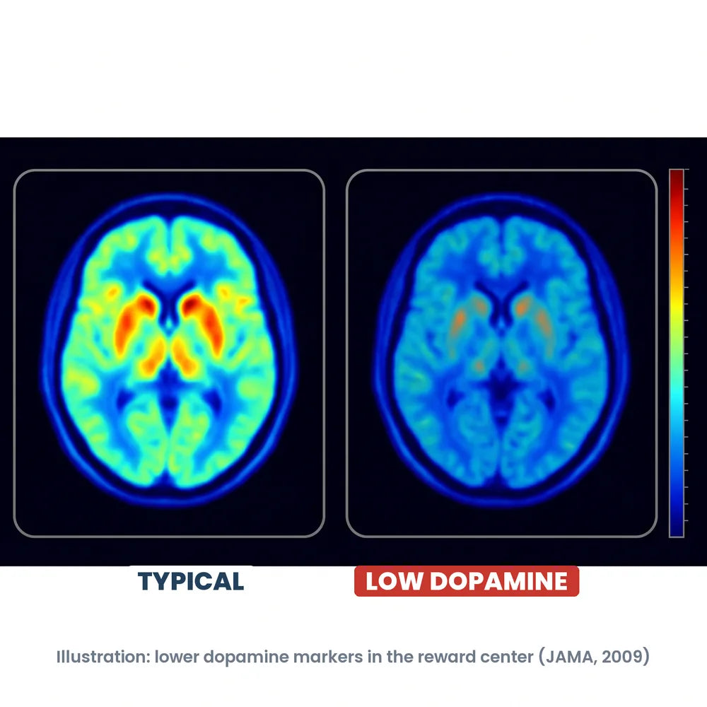 Brain scans: a typical brain next to a brain with lower dopamine in the reward center, from a JAMA brain-imaging study