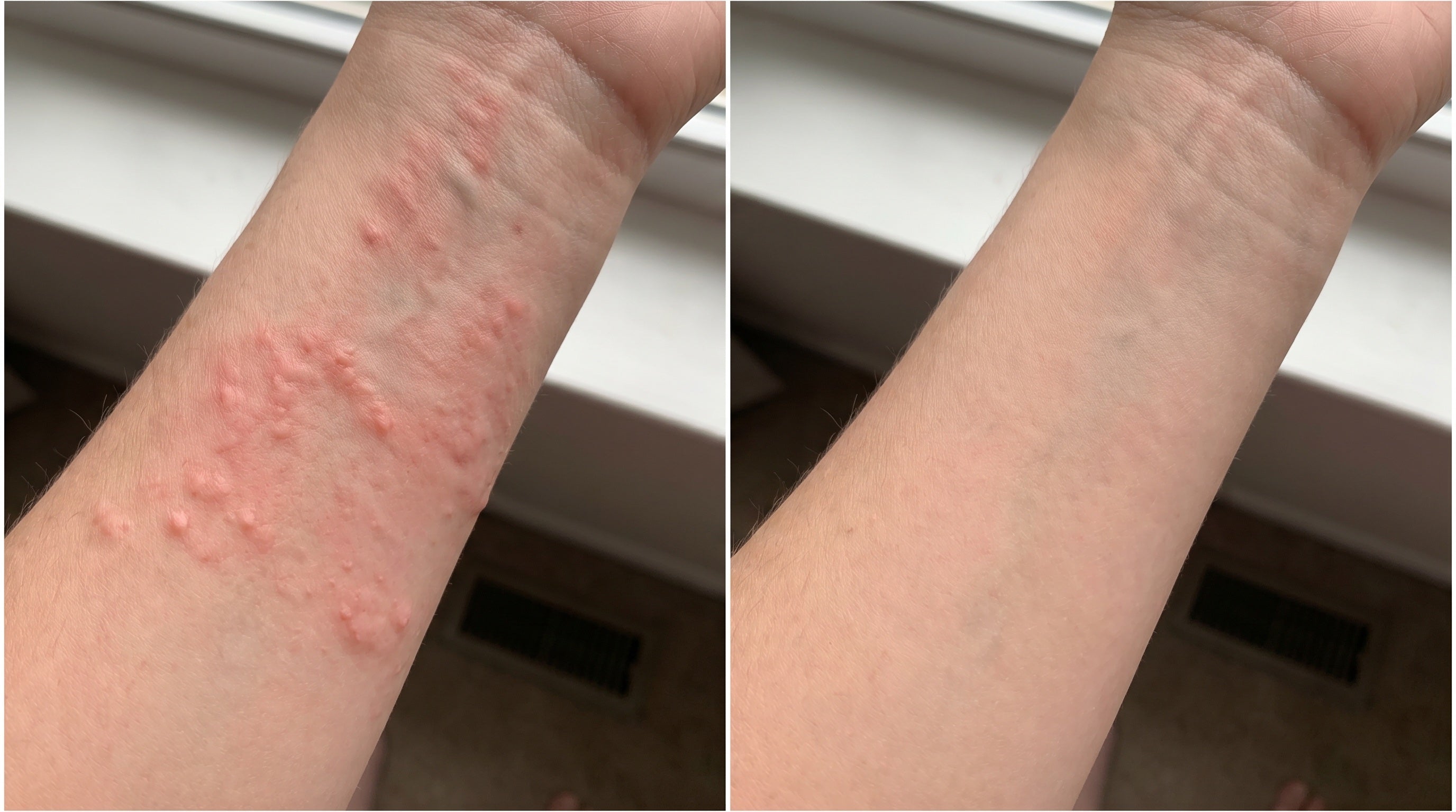 Side by side photos of a woman's forearm, left showing raised red hive welts, right showing clear calm skin