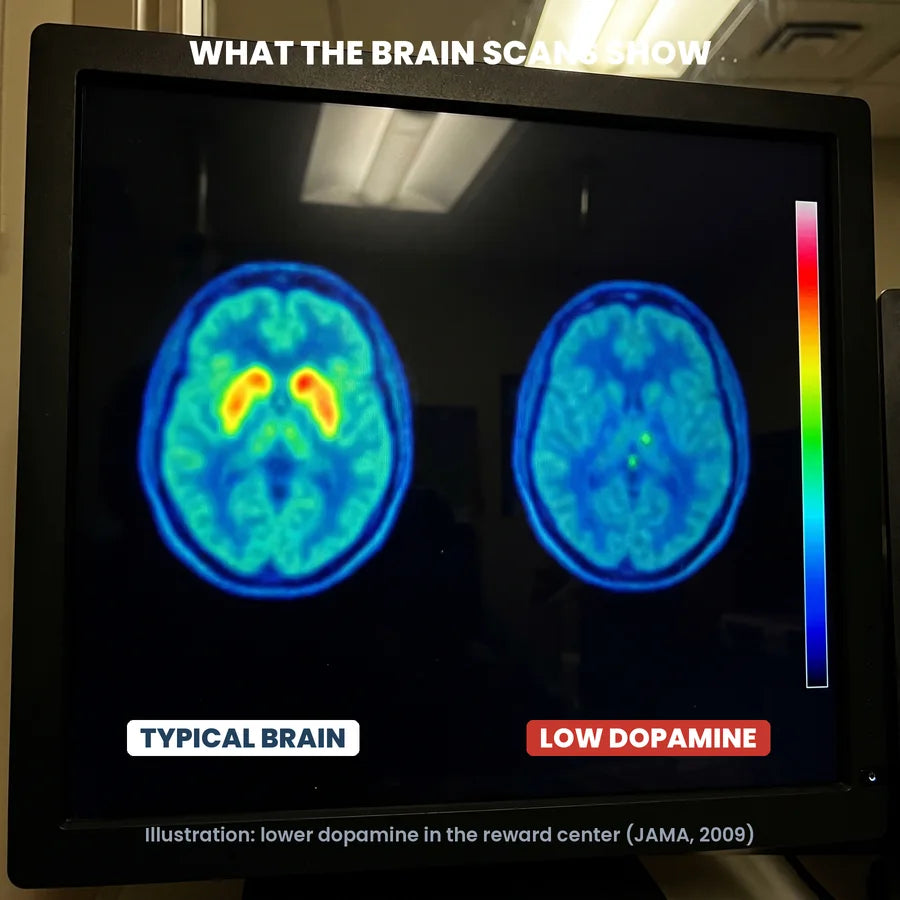 Brain scans from a JAMA study: a typical brain next to a brain with low dopamine in the reward center