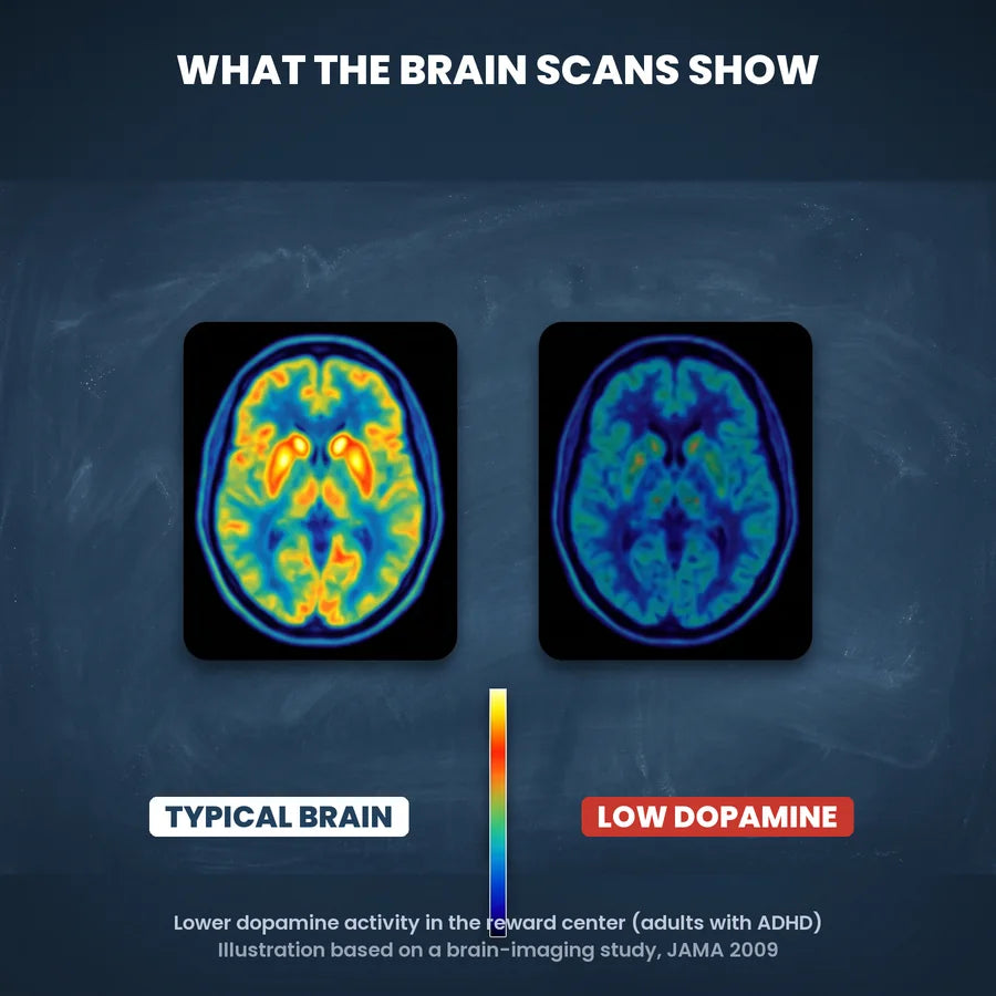 Brain scans: a typical brain lit up in the reward center next to a dim low dopamine brain, JAMA study